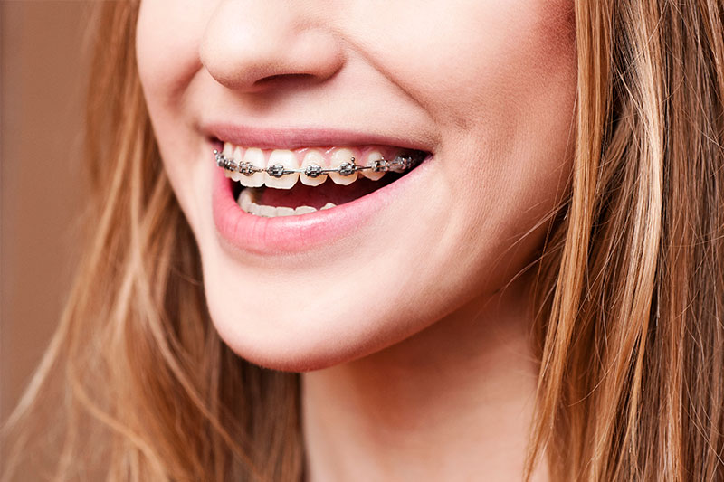 Orthodontics in Evanston